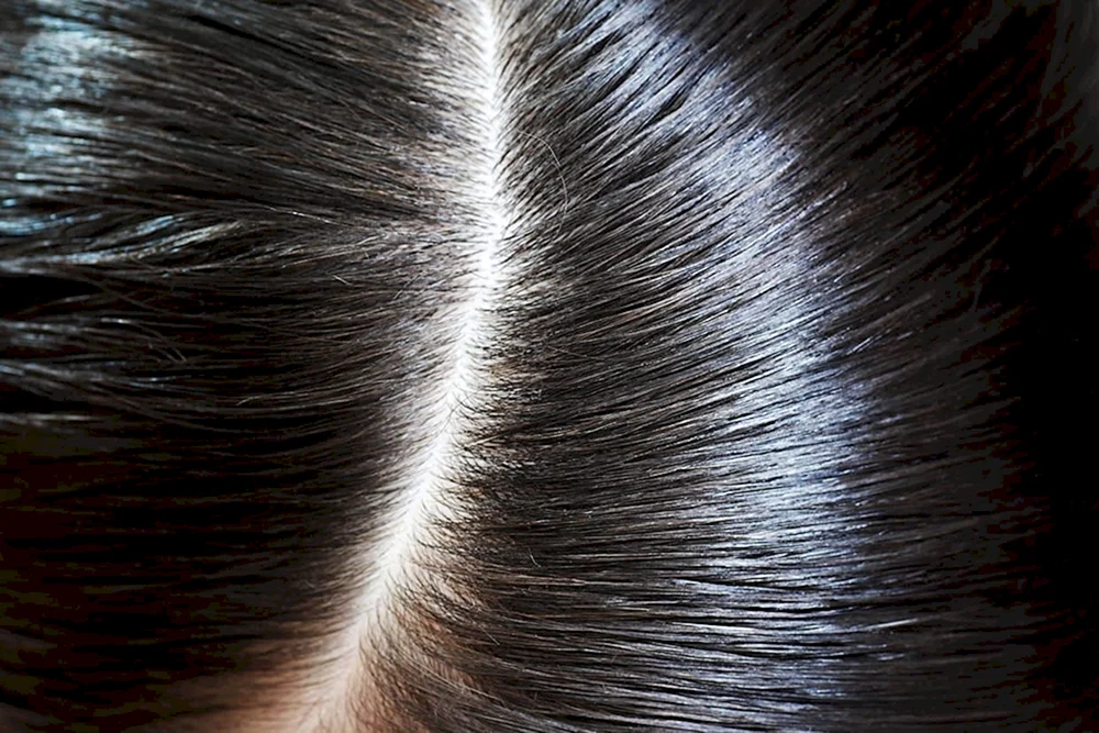 Androgenabhängige Alopezie