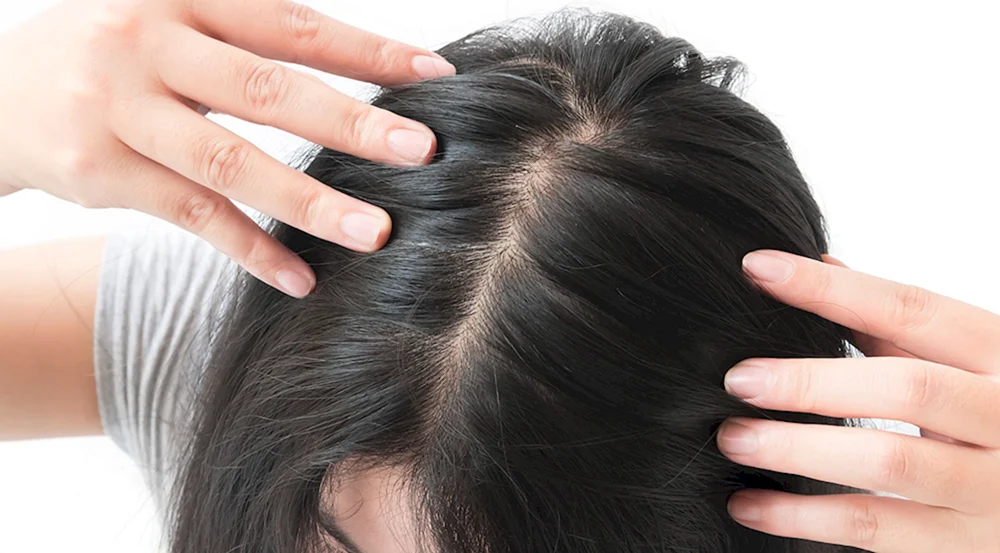 Alopecia areata